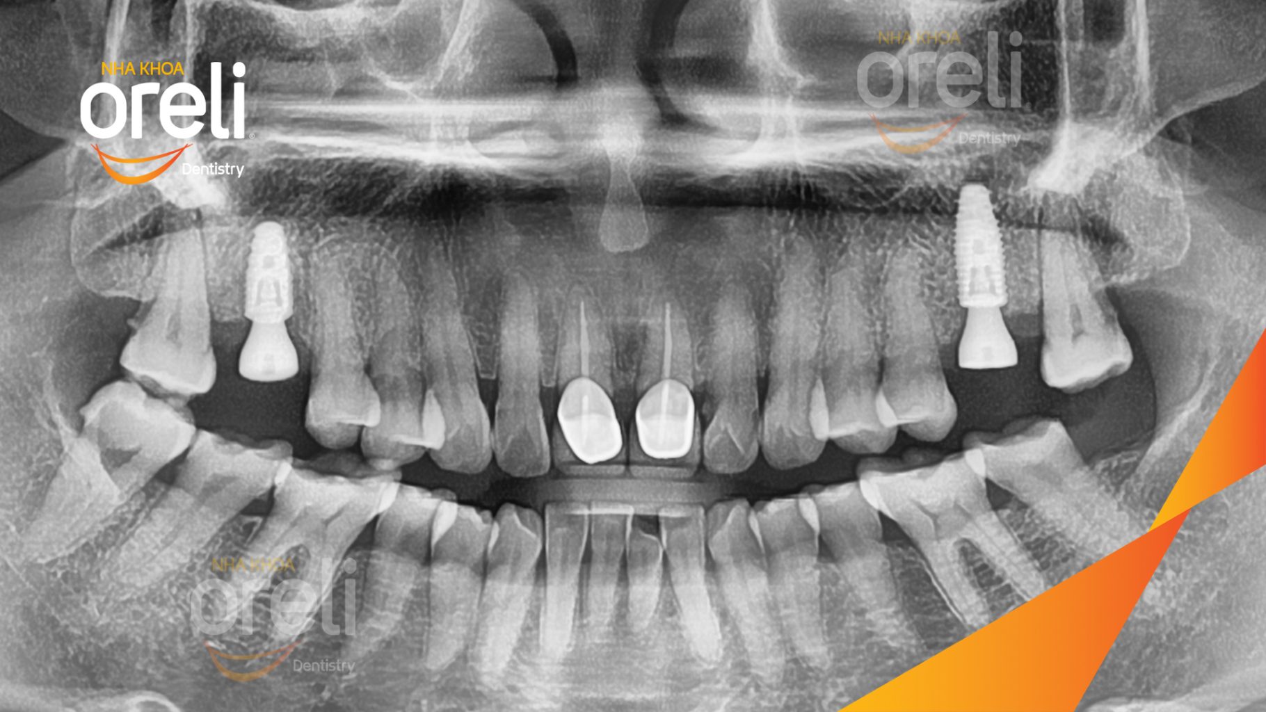Mất răng hàm trên trước khi điều trị tại Oreli