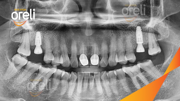 Ca Cấy Ghép Implant Phục Hồi Răng Tại Nha Khoa Oreli