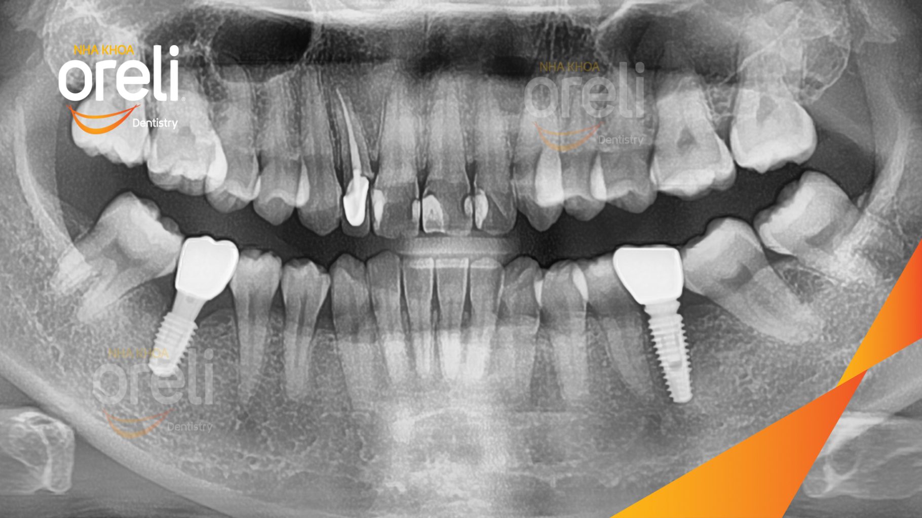 Thực hiện Cấy ghép trụ Implant chính hãng vào vùng mất răng kéo dài 3 tháng tại Oreli