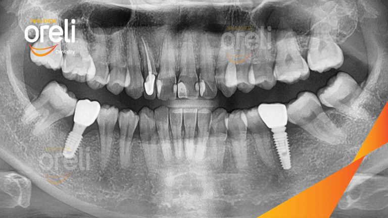 Ca Cấy 2 Trụ Implant Hàm Dưới – Case thực tế tại Oreli