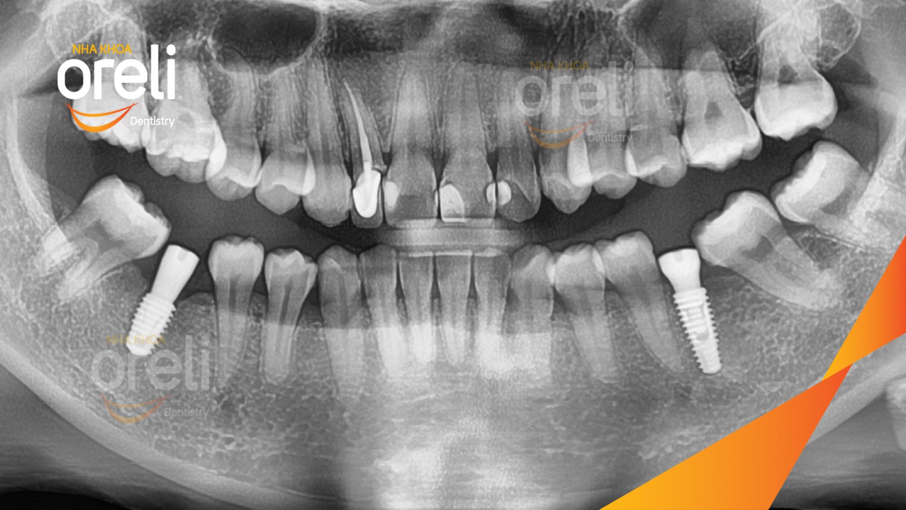 Mất răng hàm dưới trước khi điều trị tại Oreli