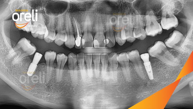 Ca Cấy 2 Trụ Implant Hàm Dưới – Case thực tế tại Oreli