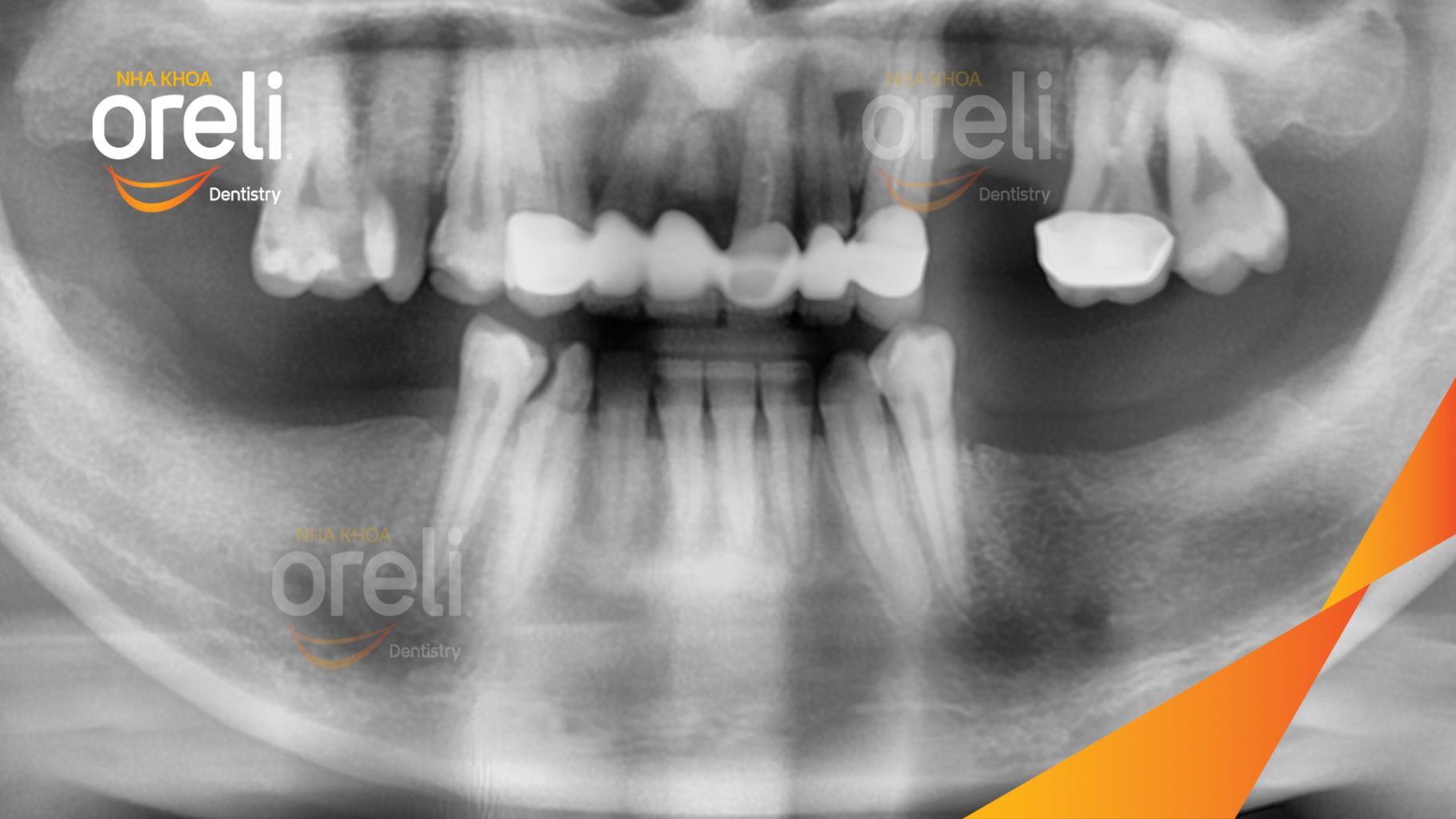 Trước điều trị: Mất răng hàm dưới tại Oreli