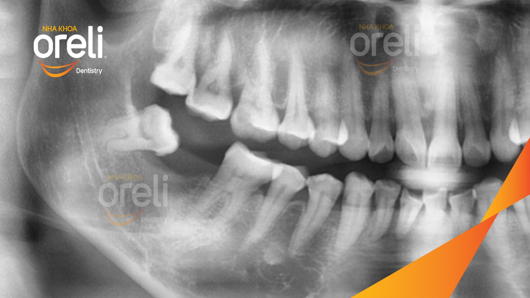 Trước điều trị: Mất răng hàm dưới tại Oreli