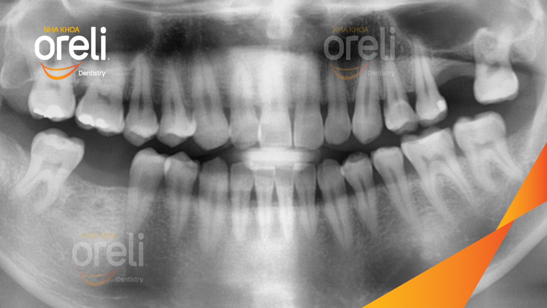 Trước điều trị: Mất răng hàm trên và dưới tại Oreli