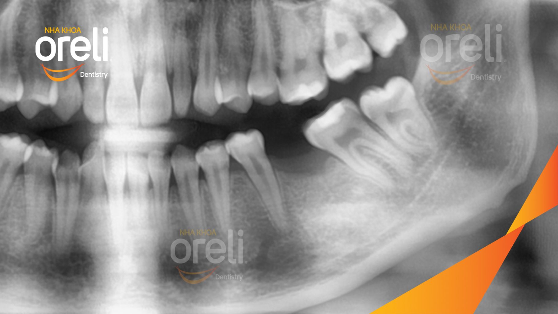 Trước điều trị: Mất răng hàm dưới thời gian dài tại Oreli