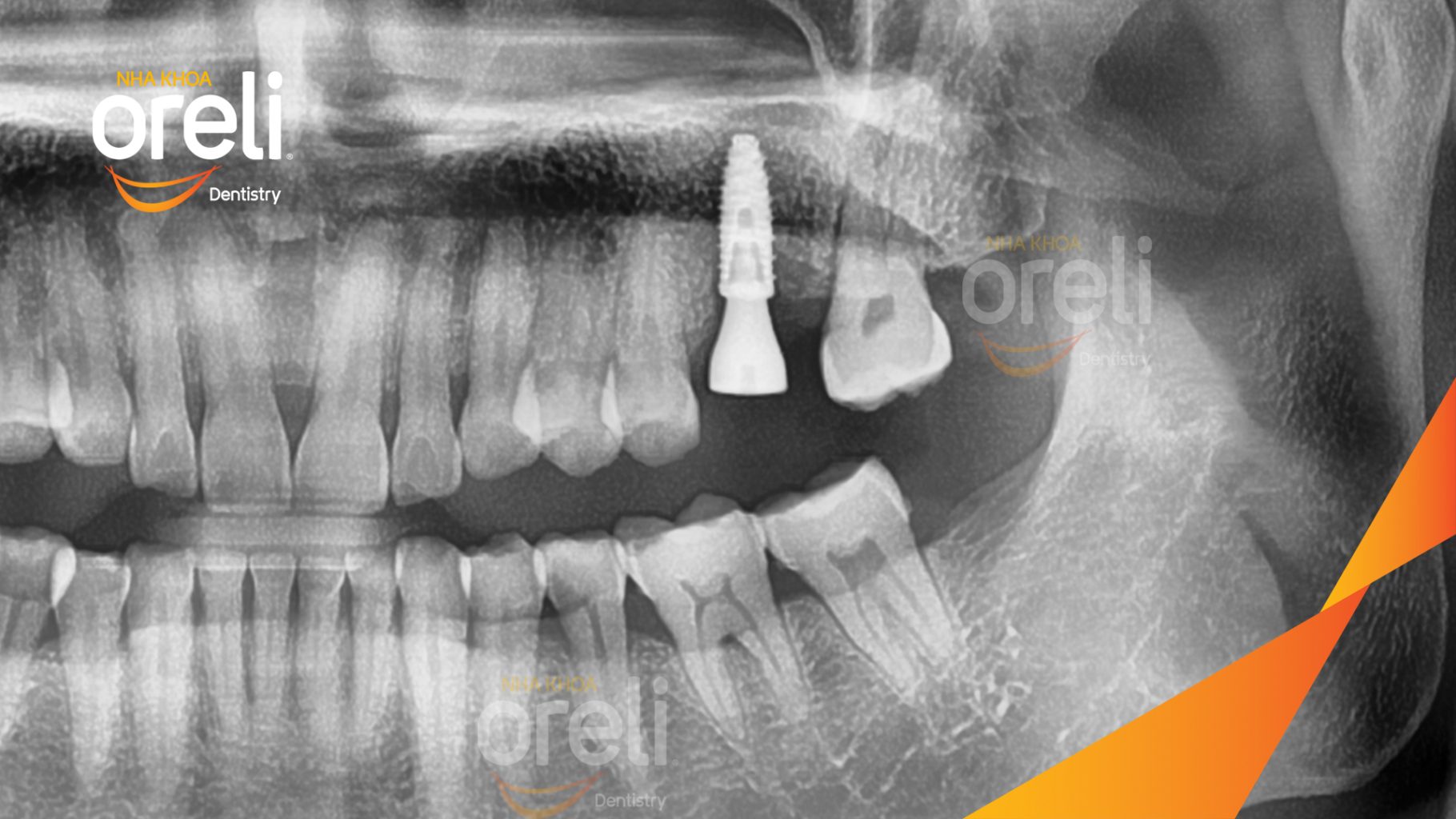 Mất răng hàm trên và dưới  trong thời gian dài trước khi điều trị tại Oreli