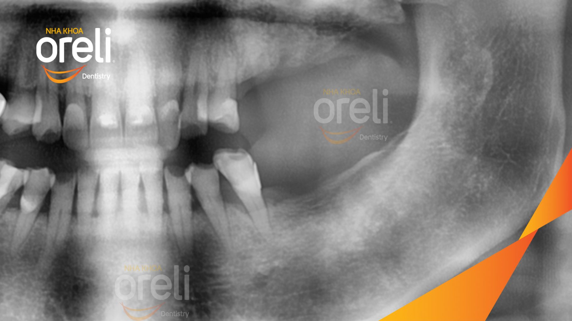 Trước điều trị: Mất răng hàm trên và dưới tại Oreli