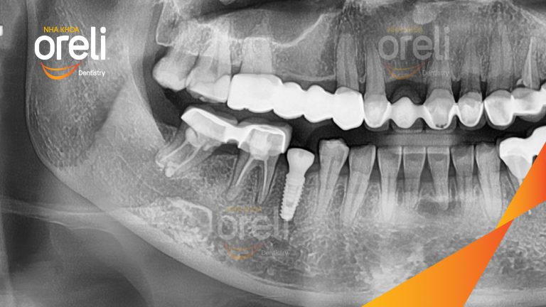 Ca Cấy Ghép Implant Phục Hồi Răng Hàm Dưới– Case thực tế tại Oreli