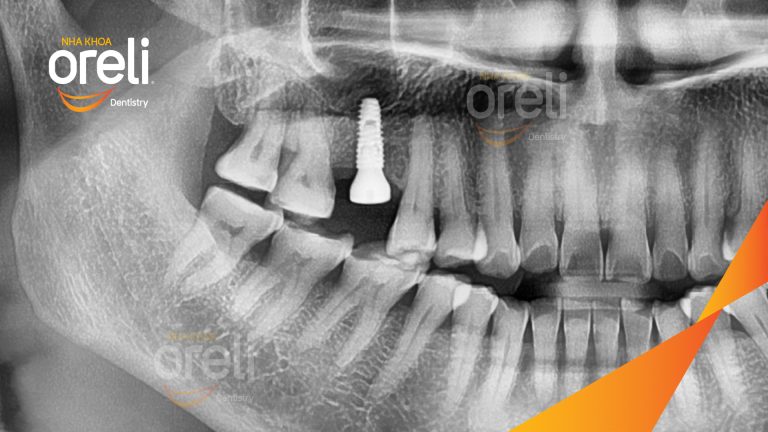 Ca Phục Hồi Răng Mất Hàm Trên Tại Nha Khoa Oreli