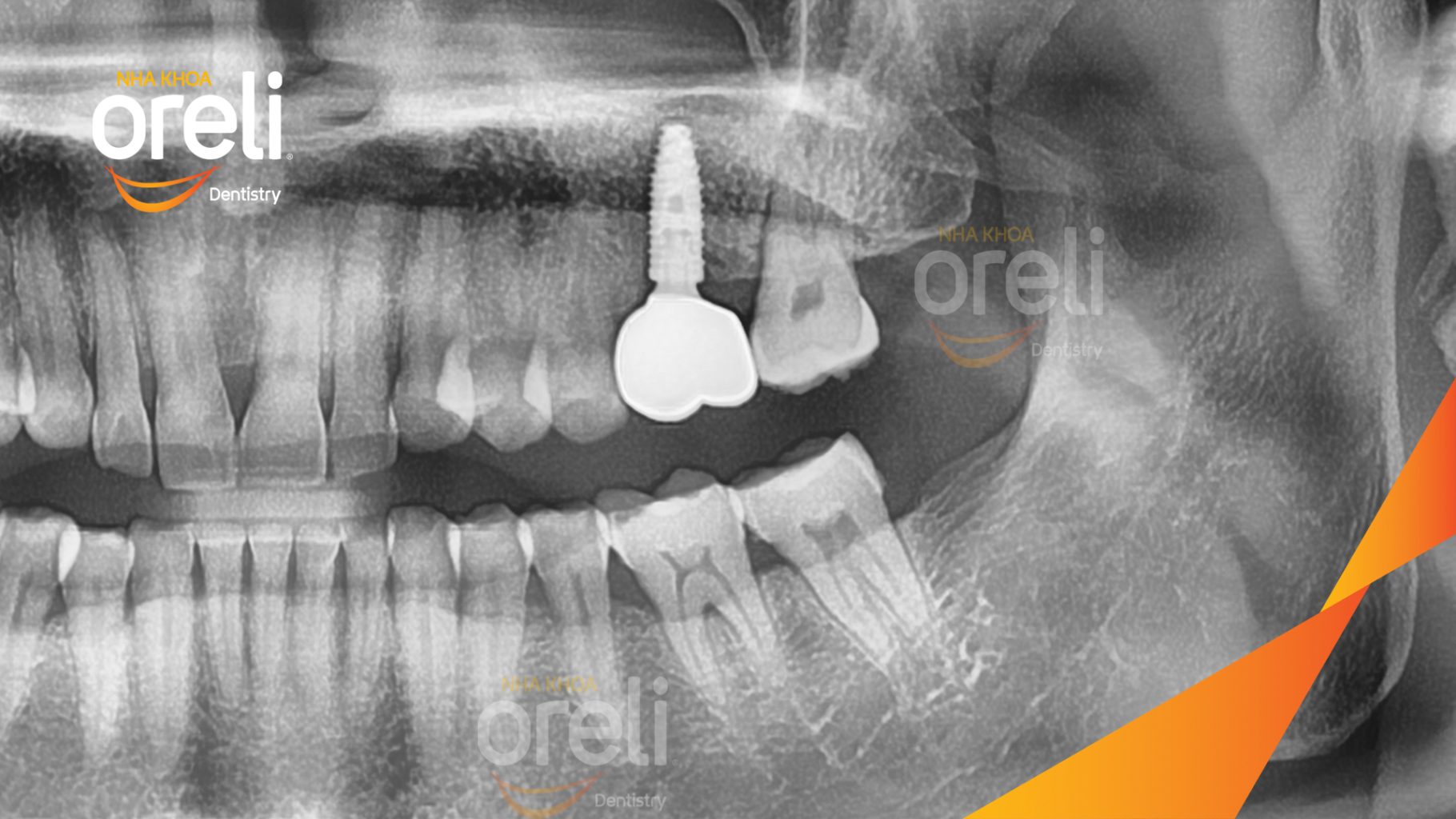Thực hiện Cấy ghép trụ Implant chính hãng vào vùng mất răng, sau đó phục hình răng trên Implant nhằm khôi phục chức năng ăn nhai và thẩm mỹ. kéo dài 3 tháng tại Oreli