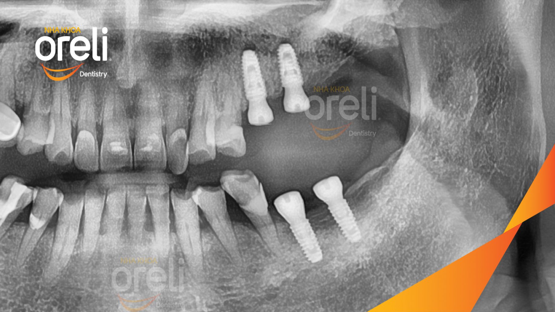 Mất răng hàm trên và dưới trước khi điều trị tại Oreli
