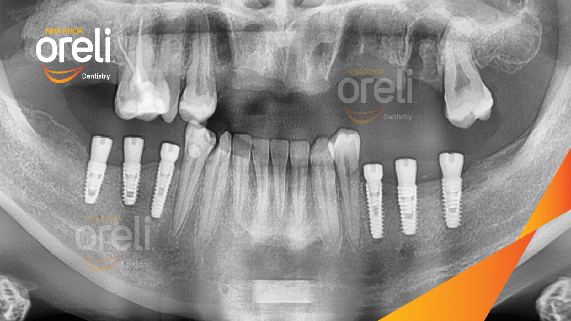 Mất răng hàm dưới trước khi điều trị tại Oreli