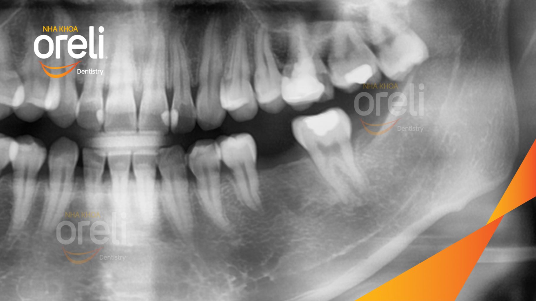 Trước điều trị: Mất răng hàm dưới tại Oreli