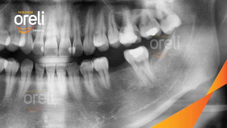 Ca Cấy Ghép 1 Trụ Implant Hàm Dưới – Case thực tế tại Oreli