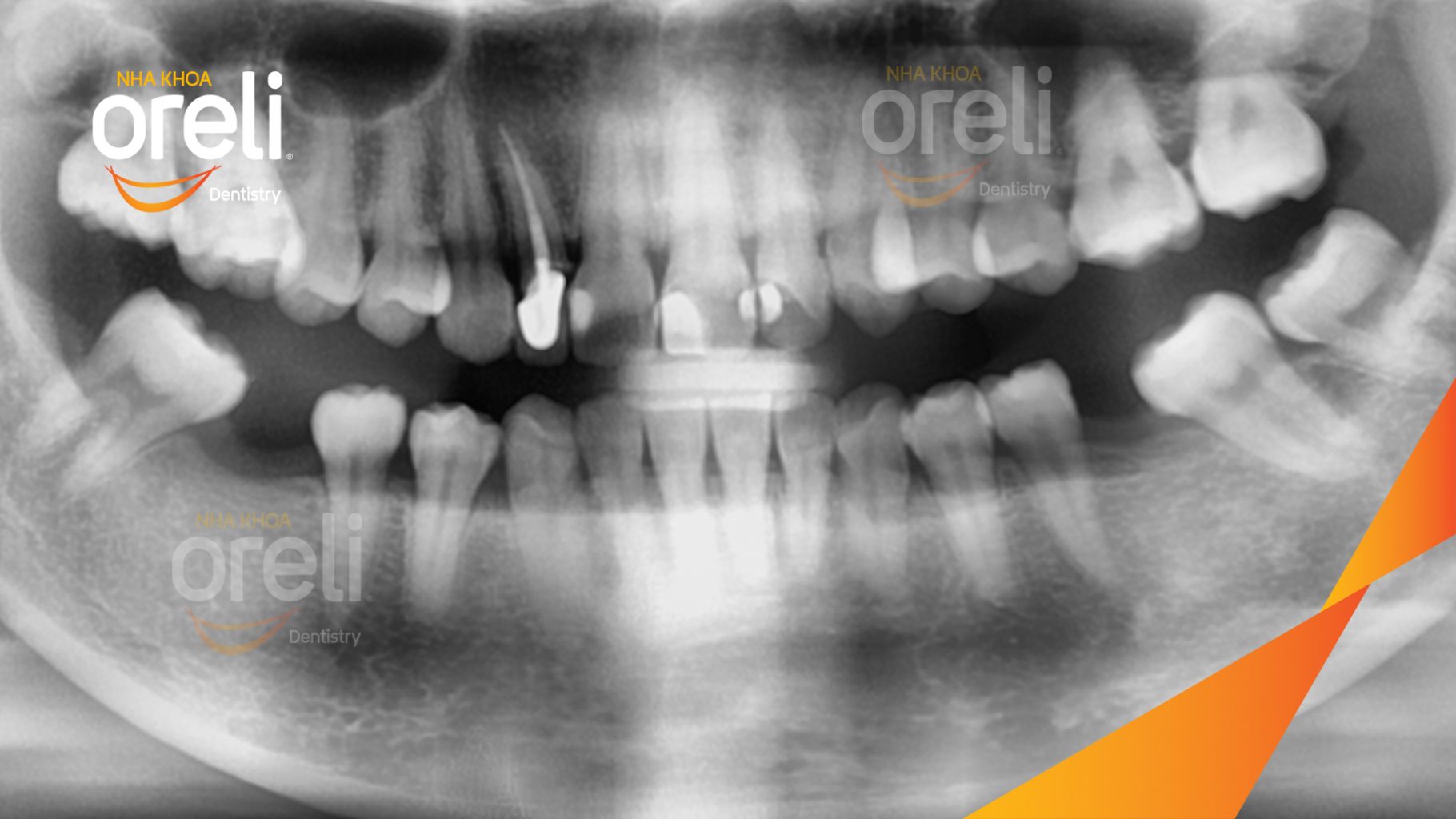 Trước điều trị: Mất răng hàm dưới tại Oreli