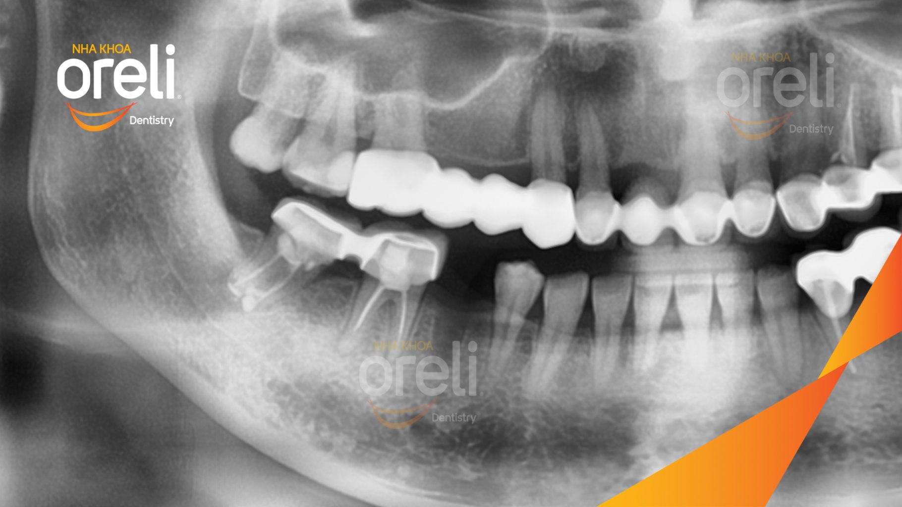 Trước điều trị: Mất răng hàm dưới tại Oreli