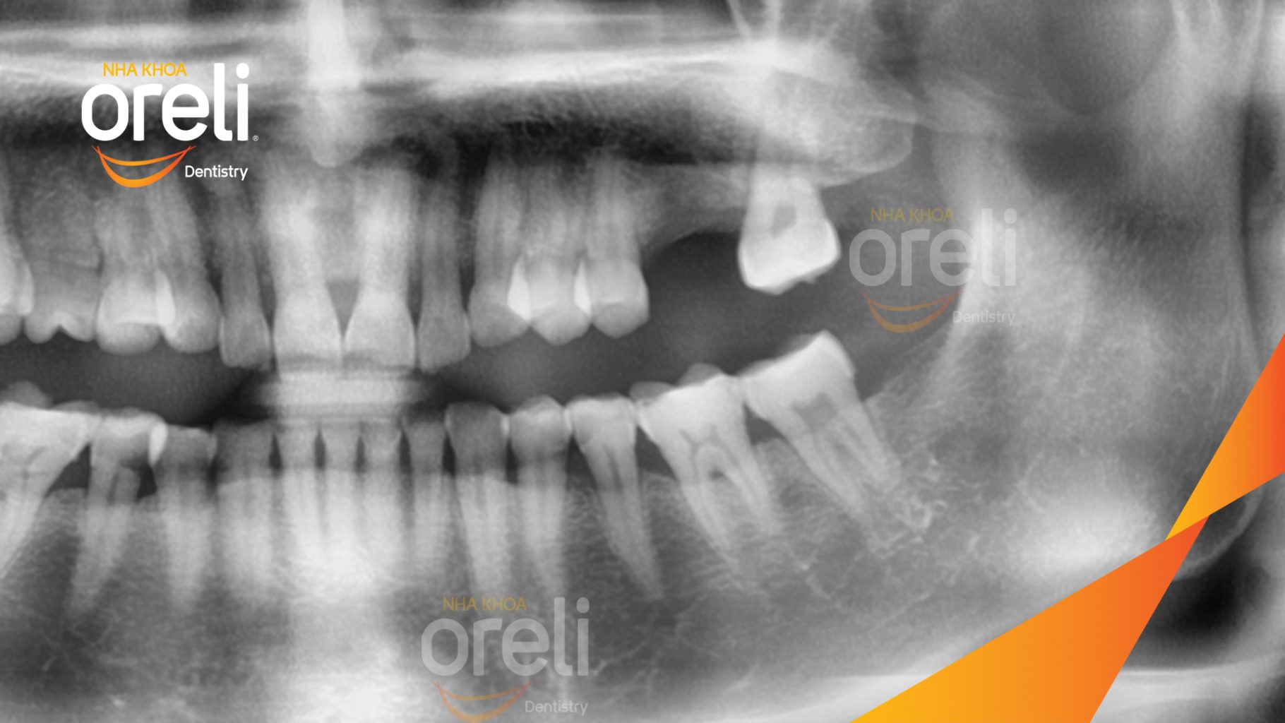 Trước điều trị: Mất răng hàm trên và dưới  trong thời gian dài tại Oreli