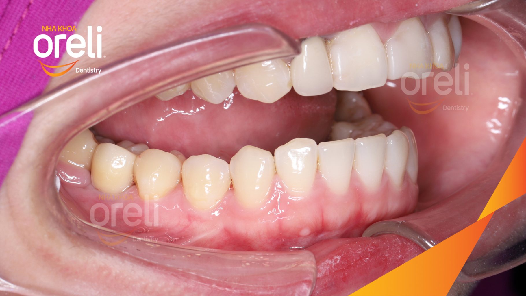 Kết quả sau 3 tháng: Hoàn thành đặt trụ Implant đúng vị trí mất răng tại Oreli