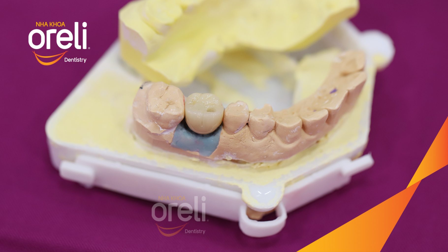 Quá trình Cấy ghép trụ Implant chính hãng vào vùng mất răng, sau đó phục hình răng trên Implant nhằm khôi phục chức năng ăn nhai và thẩm mỹ. trong 3 tháng tại Oreli