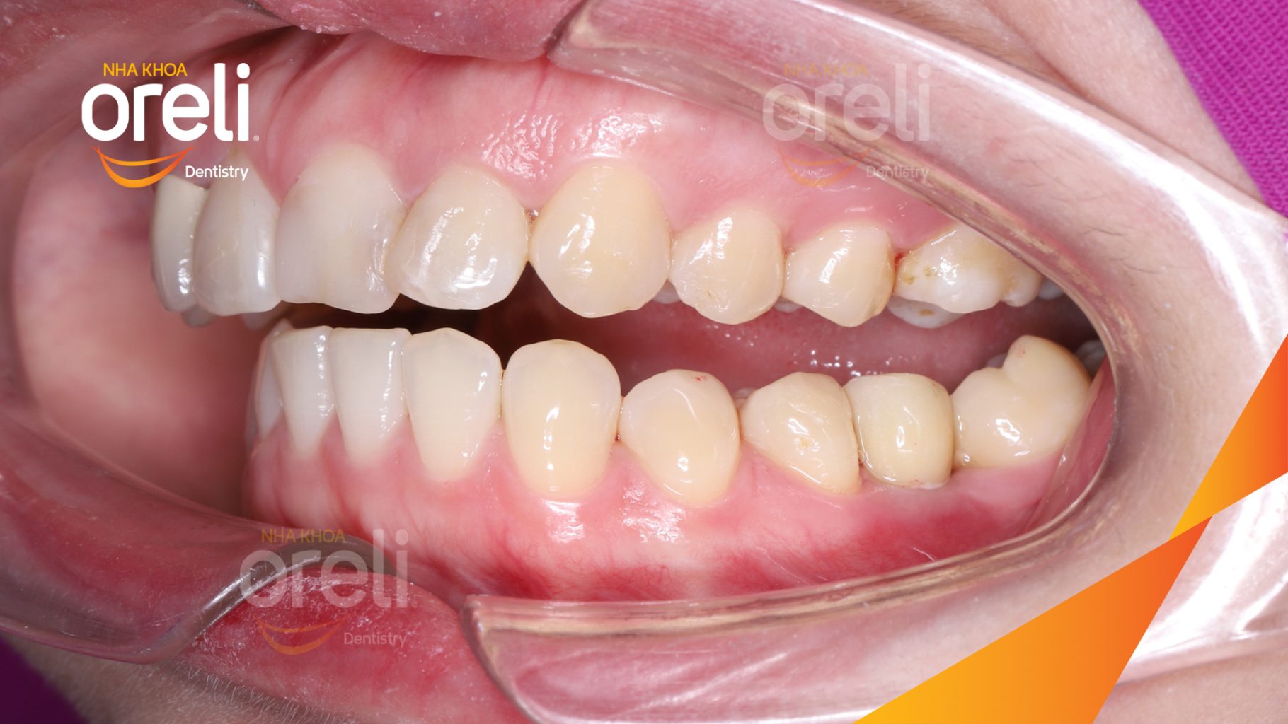 Kết quả đạt được sau 3 tháng - Hoàn thành đặt trụ Implant đúng vị trí mất răng tại Oreli