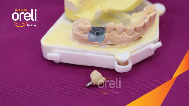 Ca Cấy Ghép Implant Phục Hồi Răng Mất Hàm Trên – Case thực tế tại Oreli