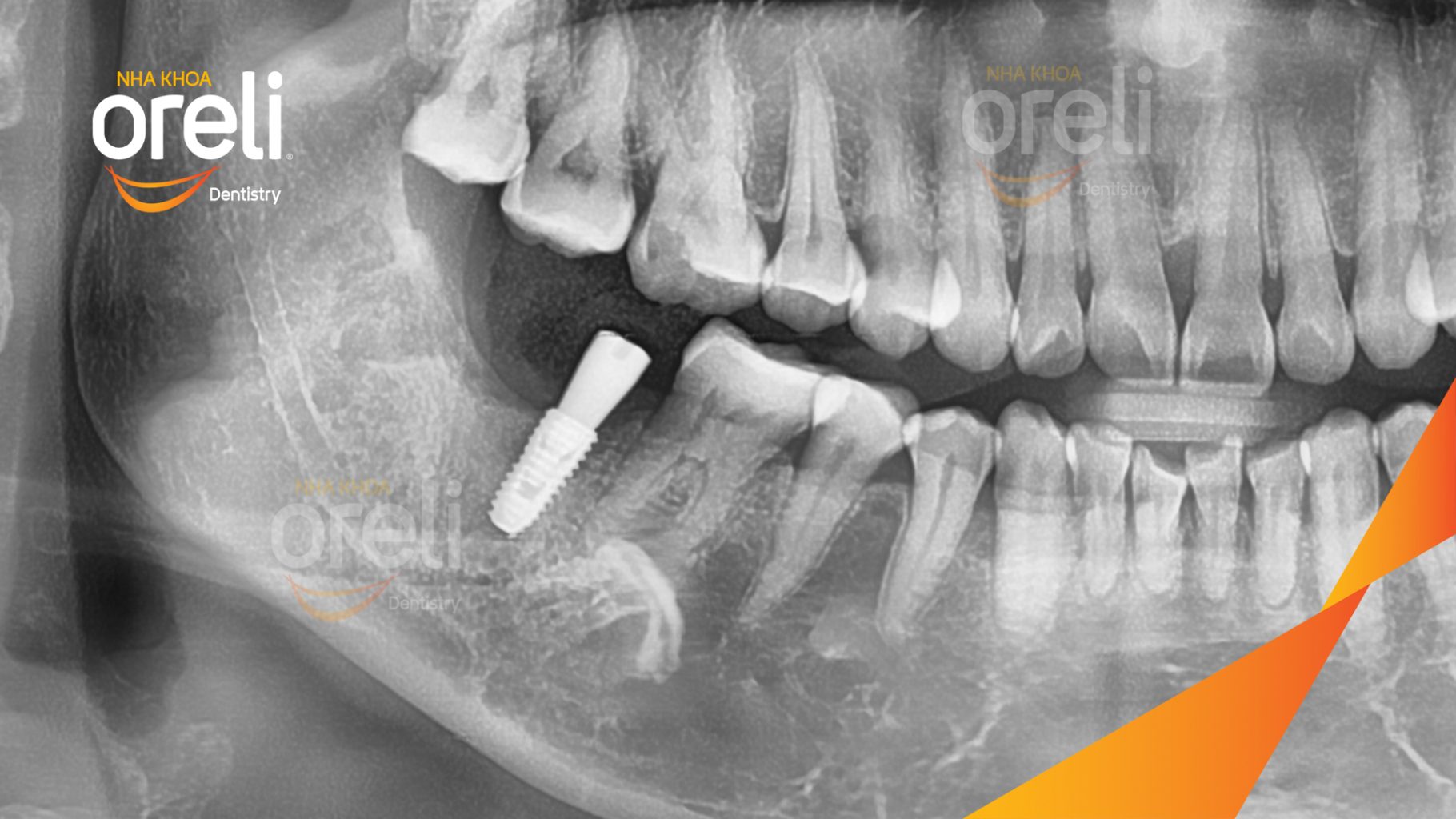 Mất răng hàm dưới trước khi điều trị tại Oreli