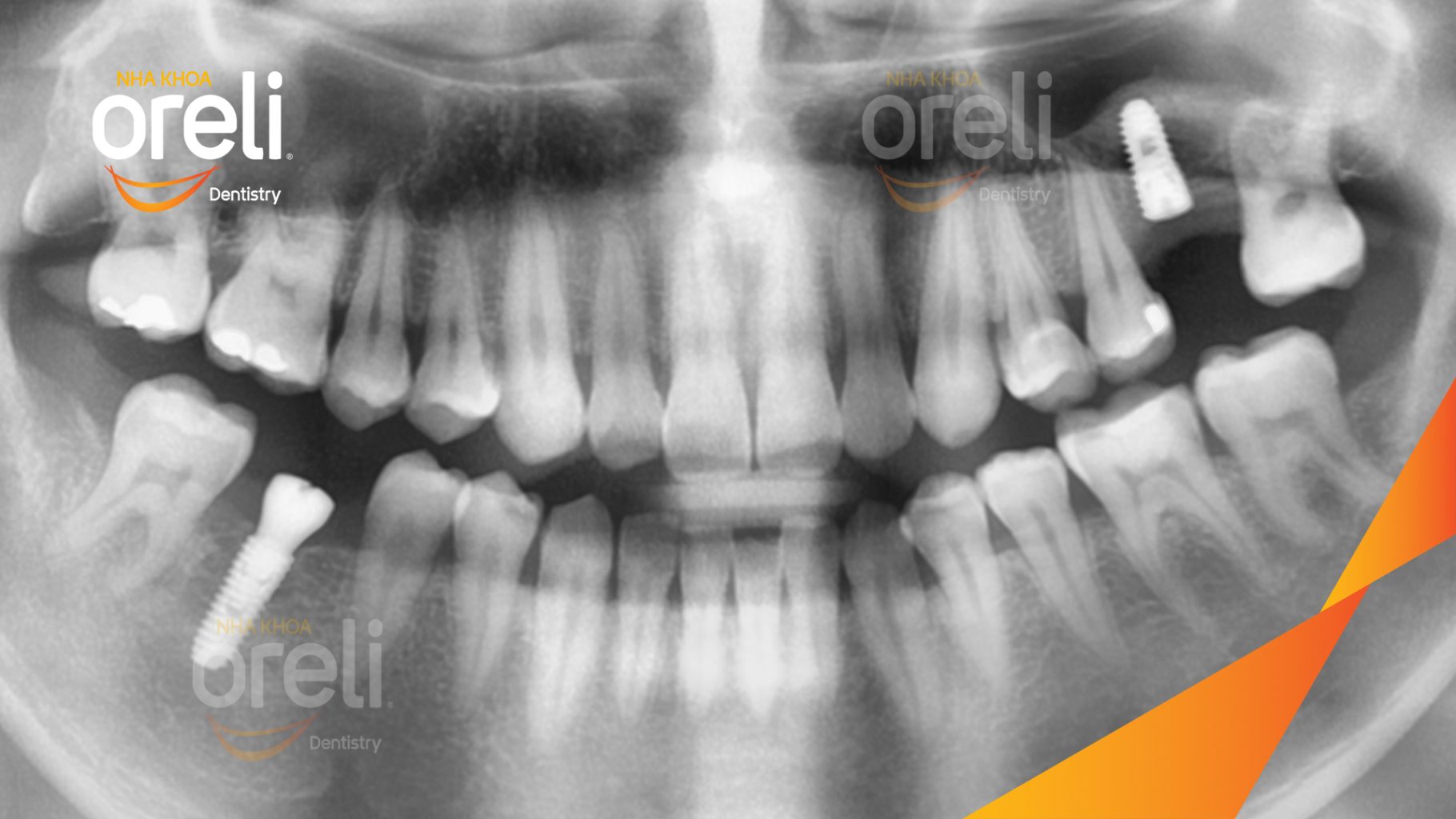 Mất răng hàm trên và dưới trước khi điều trị tại Oreli