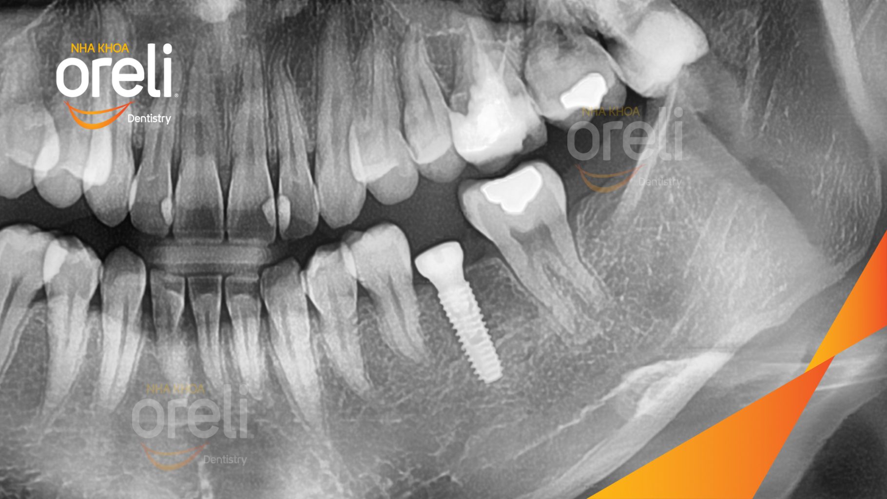 Mất răng hàm dưới trước khi điều trị tại Oreli