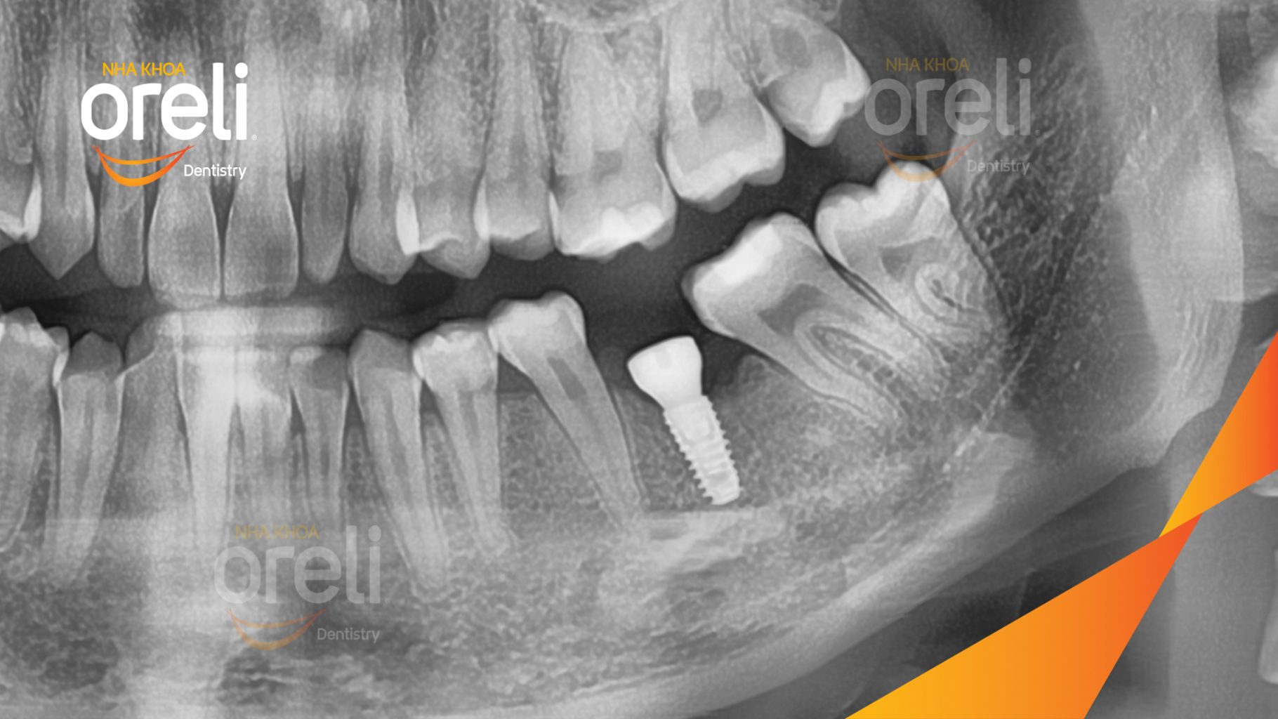 Mất răng hàm dưới thời gian dài trước khi điều trị tại Oreli