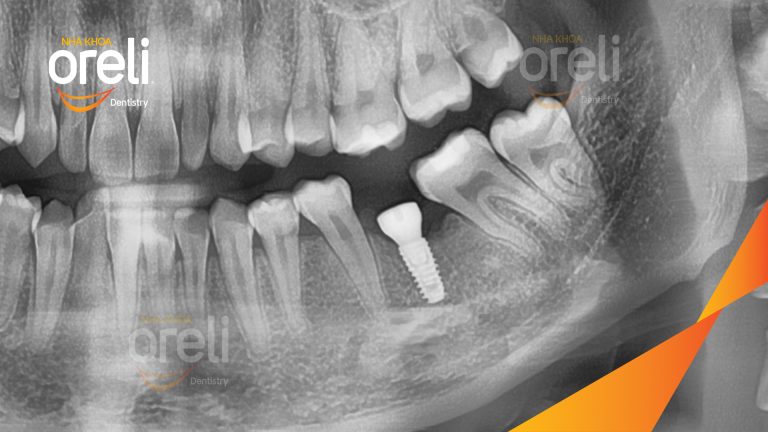 Ca Cấy Ghép Implant Phục Hồi Răng Hàm Dưới Tại Nha Khoa Oreli