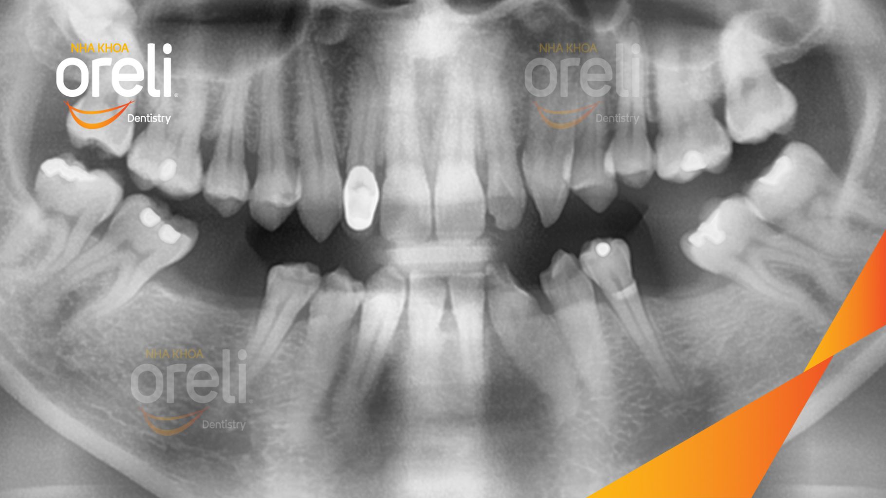 Trước điều trị: Mất răng hàm dưới tại Oreli