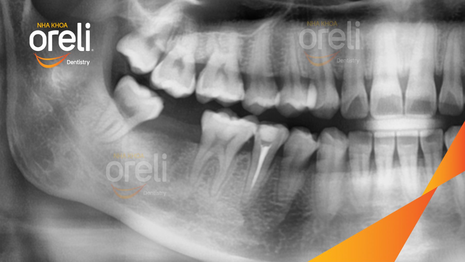 Trước điều trị: Mất răng hàm dưới tại Oreli