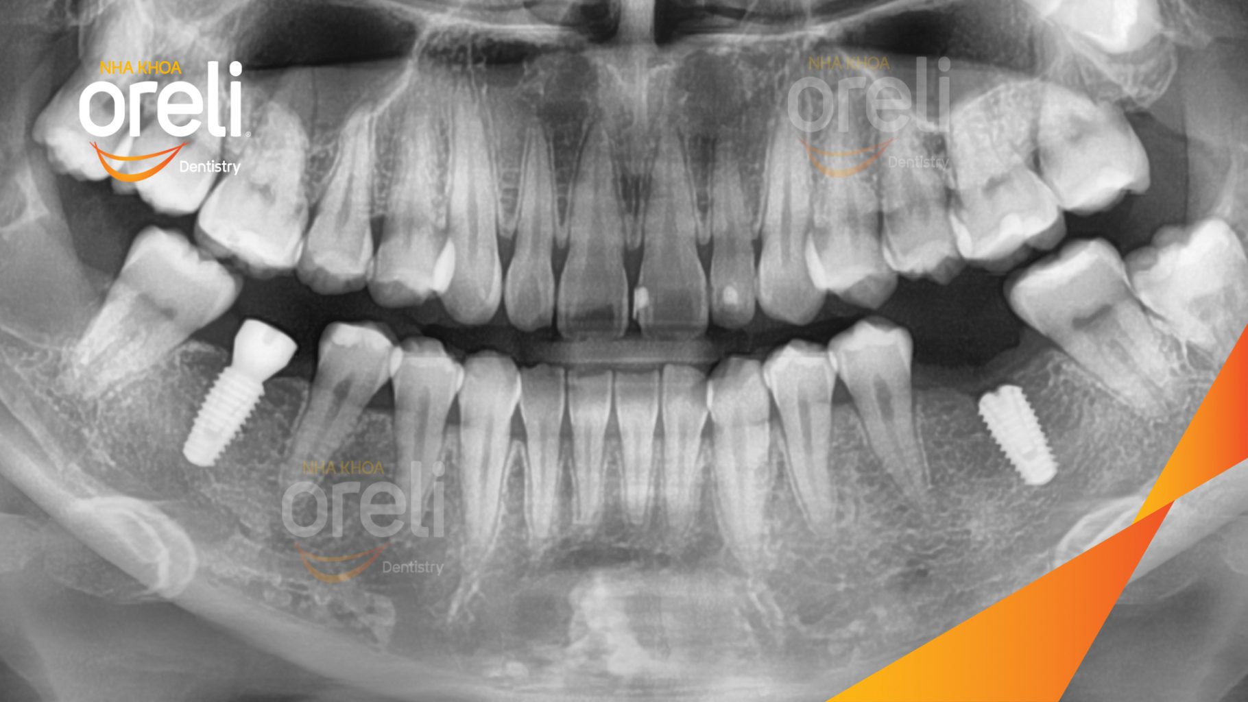 Mất răng hàm dưới trước khi điều trị tại Oreli
