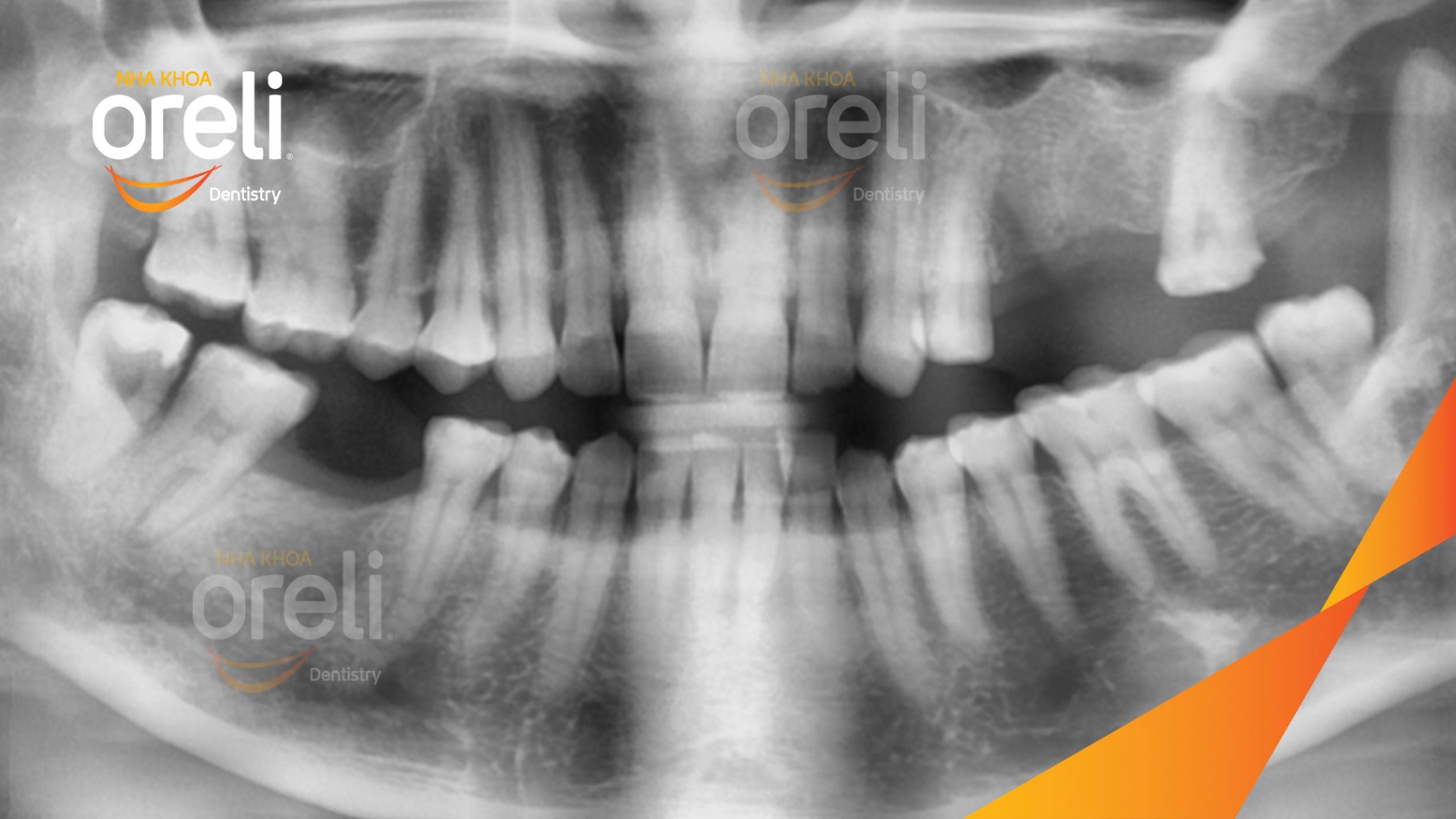 Trước điều trị: Mất răng hàm trên và dưới tại Oreli