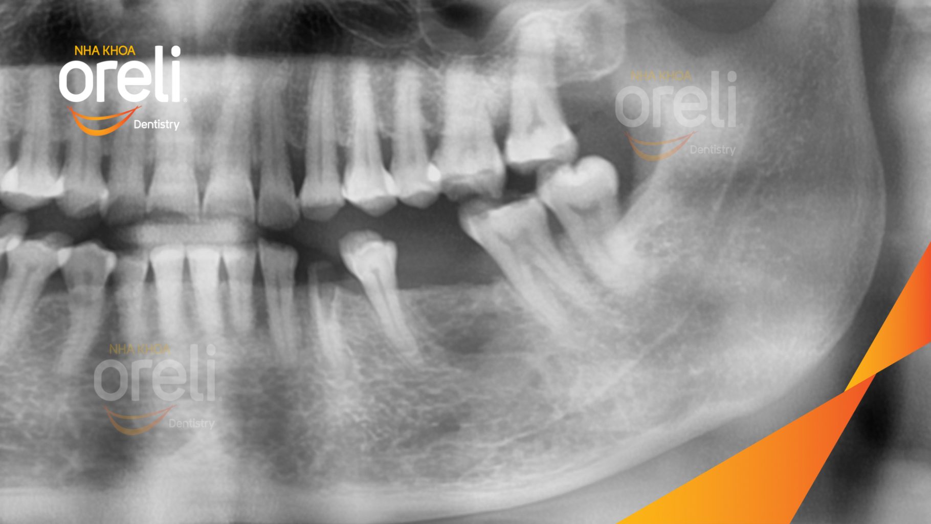 Trước điều trị: Mất răng hàm dưới tại Oreli