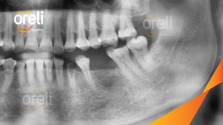 Ca Cấy Ghép Implant Hàm Dưới – Case thực tế tại Oreli
