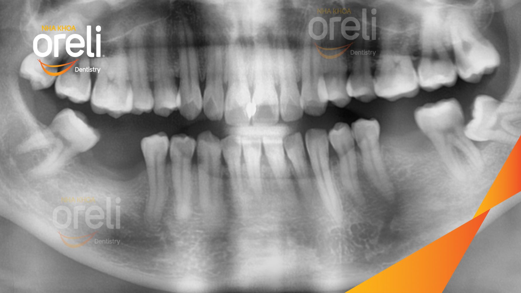 Trước điều trị: Mất răng hàm dưới tại Oreli