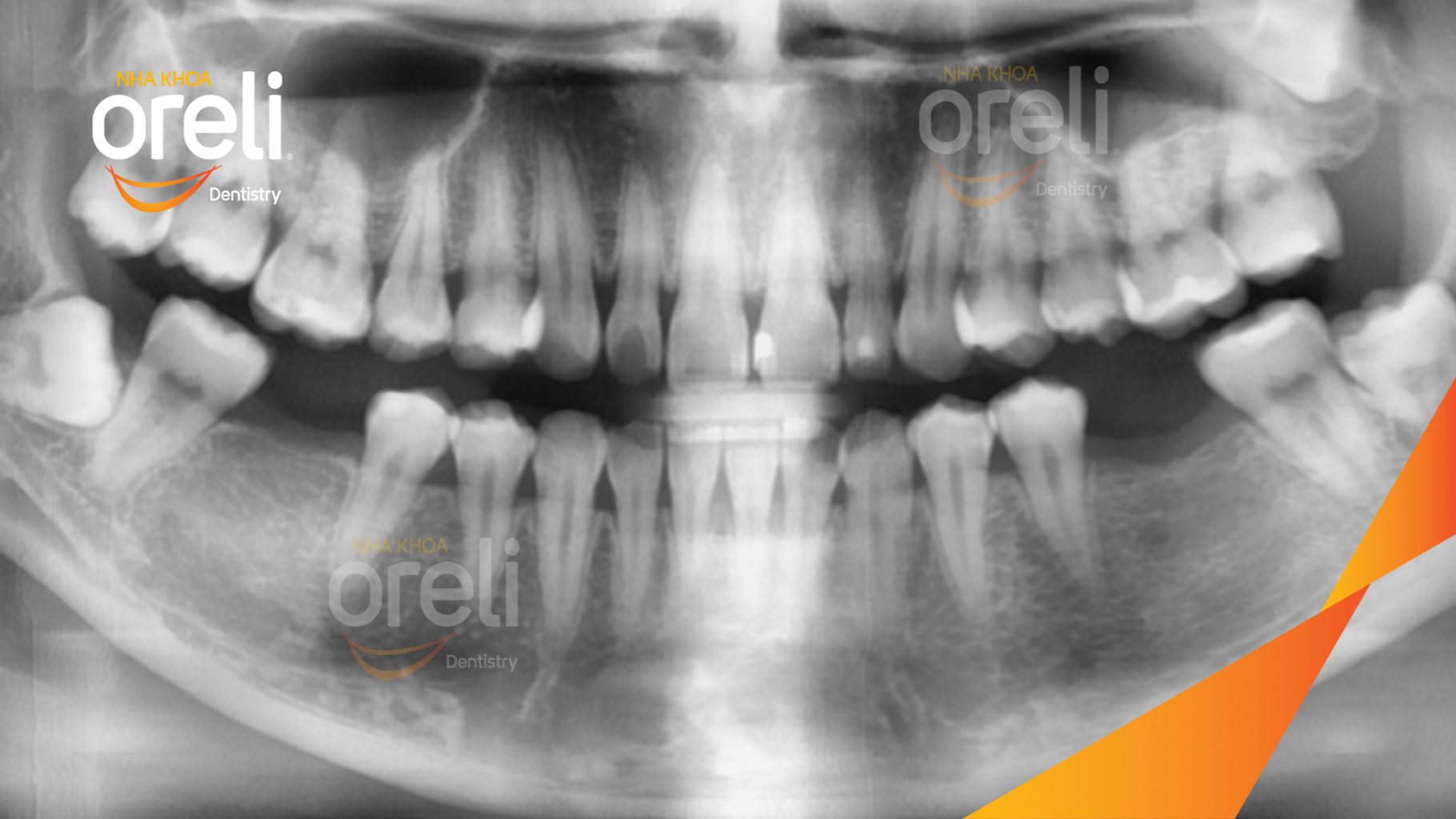 Trước điều trị: Mất răng hàm dưới tại Oreli