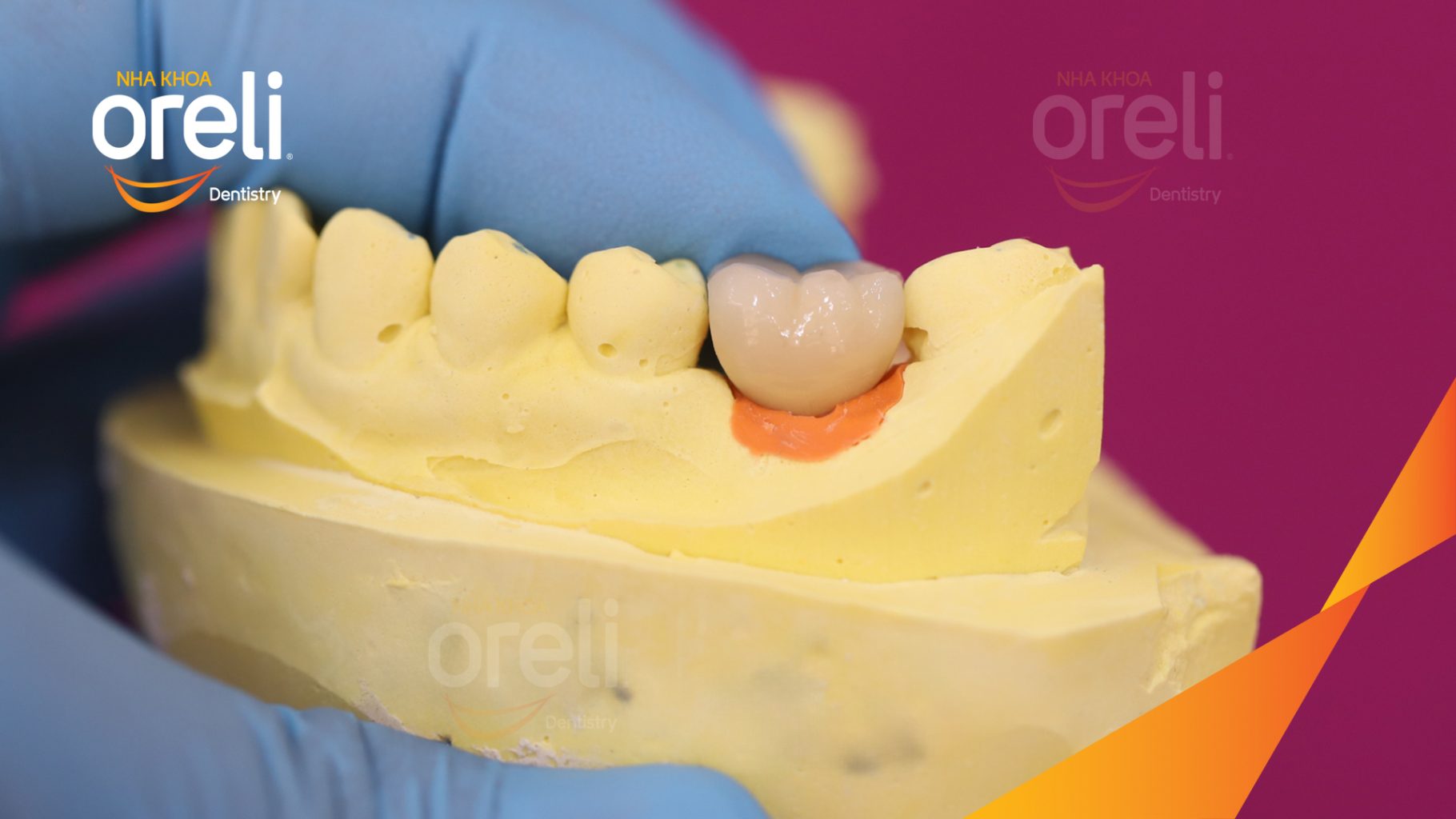 Kết quả đạt được sau 3 tháng - Hoàn thành đặt trụ Implant đúng vị trí mất răng tại Oreli