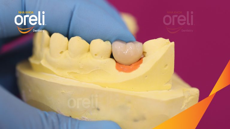 Ca Cấy Ghép Implant Hàm Dưới – Case thực tế tại Oreli