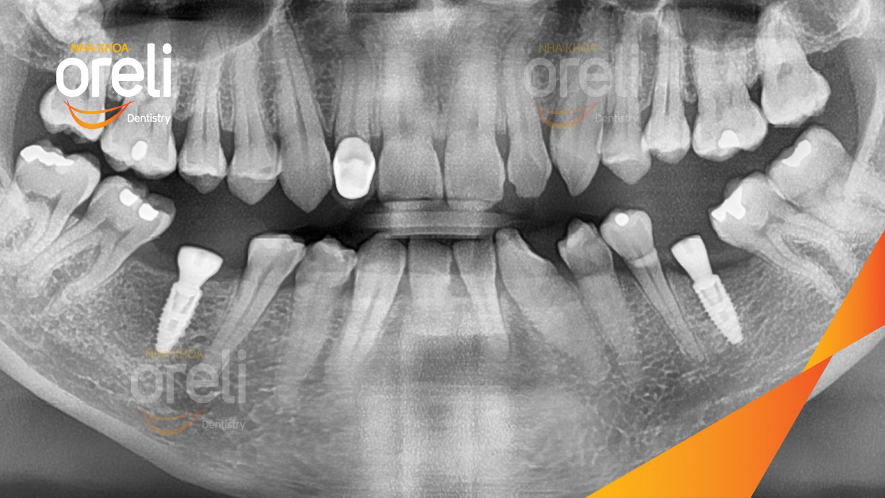 Mất răng hàm dưới trước khi điều trị tại Oreli