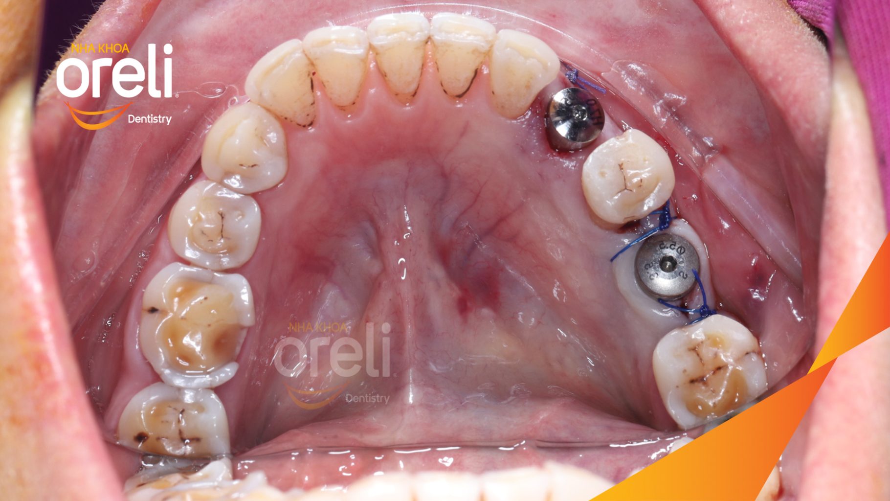Quá trình Cấy ghép trụ Implant chính hãng vào vùng mất răng trong 3 tháng tại Oreli