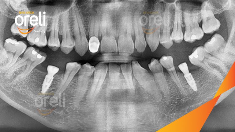 Ca Cấy Ghép Implant Hàm Dưới – Case thực tế tại Oreli