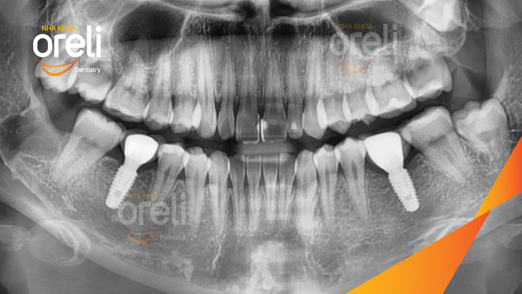 Thực hiện Cấy ghép trụ Implant chính hãng vào vùng mất răng kéo dài 3 tháng tại Oreli