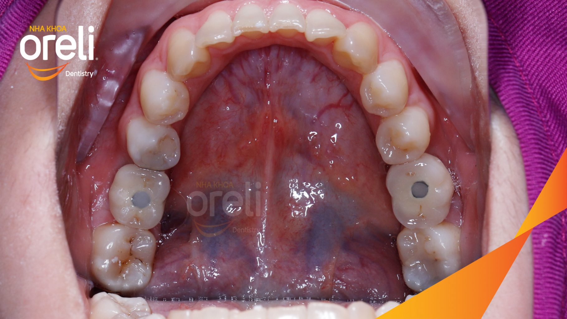 Kết quả sau 3 tháng: Hoàn thành đặt trụ Implant đúng vị trí mất răng tại Oreli