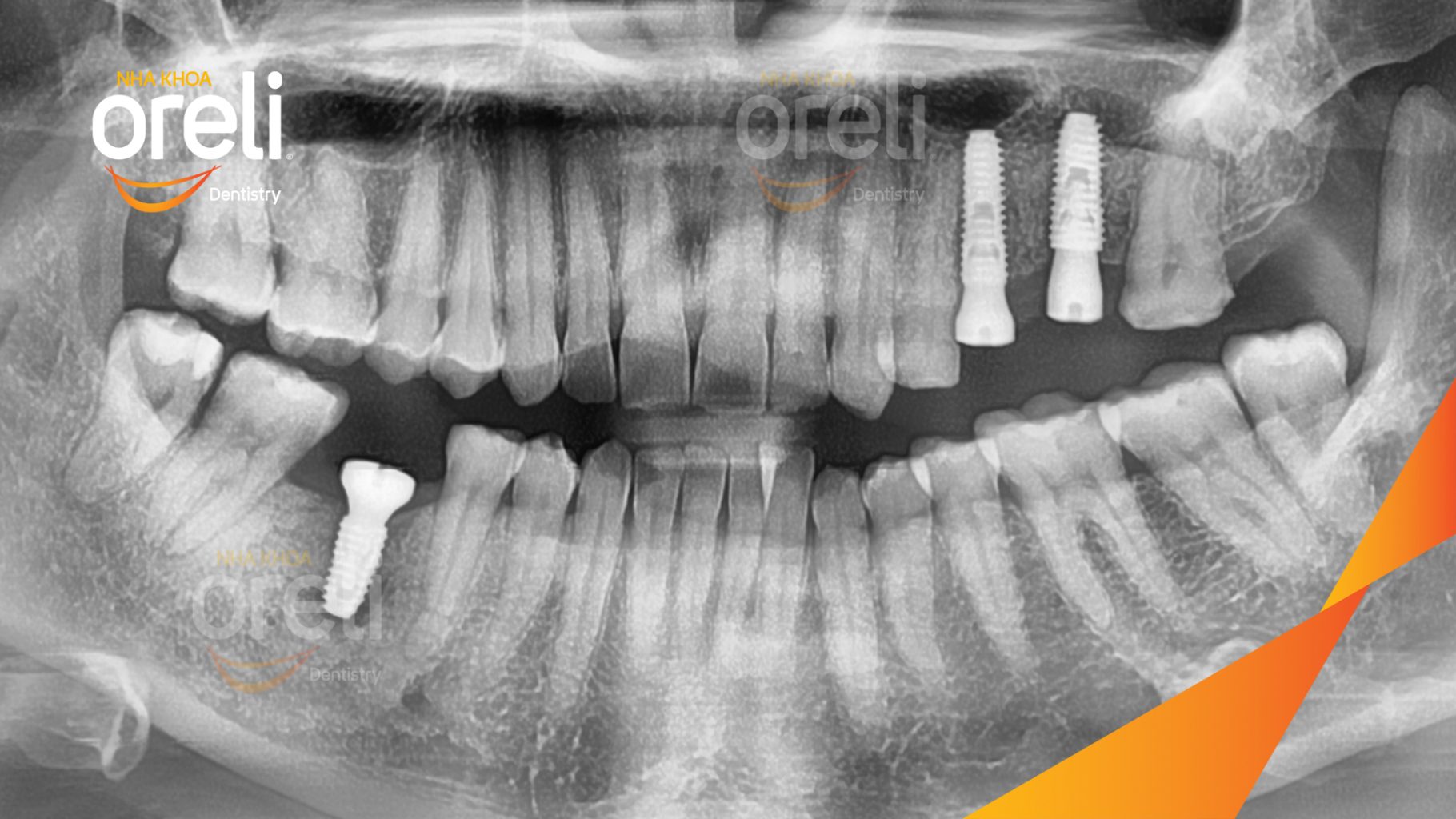 Mất răng hàm trên và dưới trước khi điều trị tại Oreli
