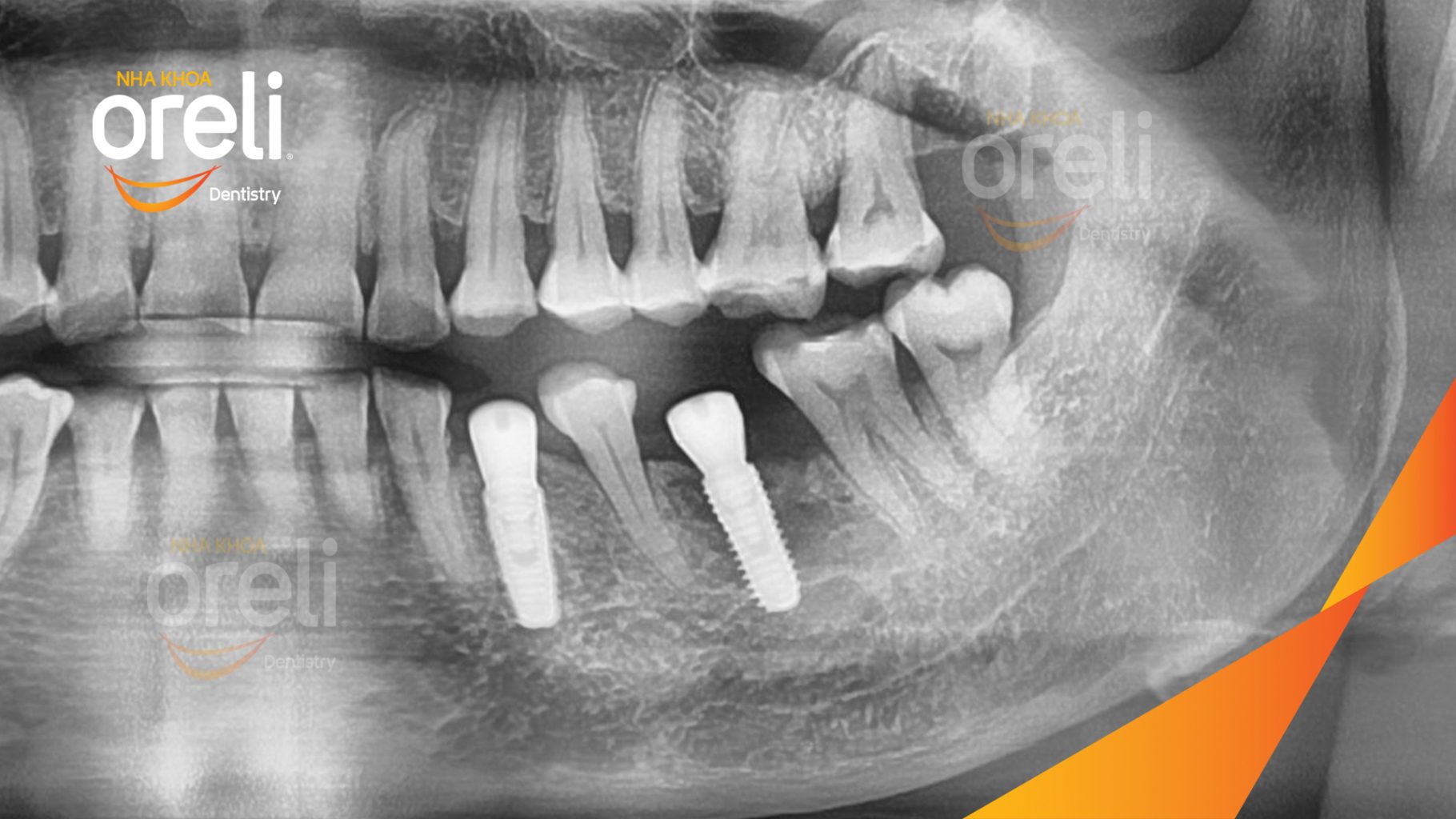 Mất răng hàm dưới trước khi điều trị tại Oreli