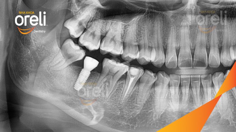 Ca Cấy Ghép Implant Phục Hồi Răng Tại Nha Khoa Oreli