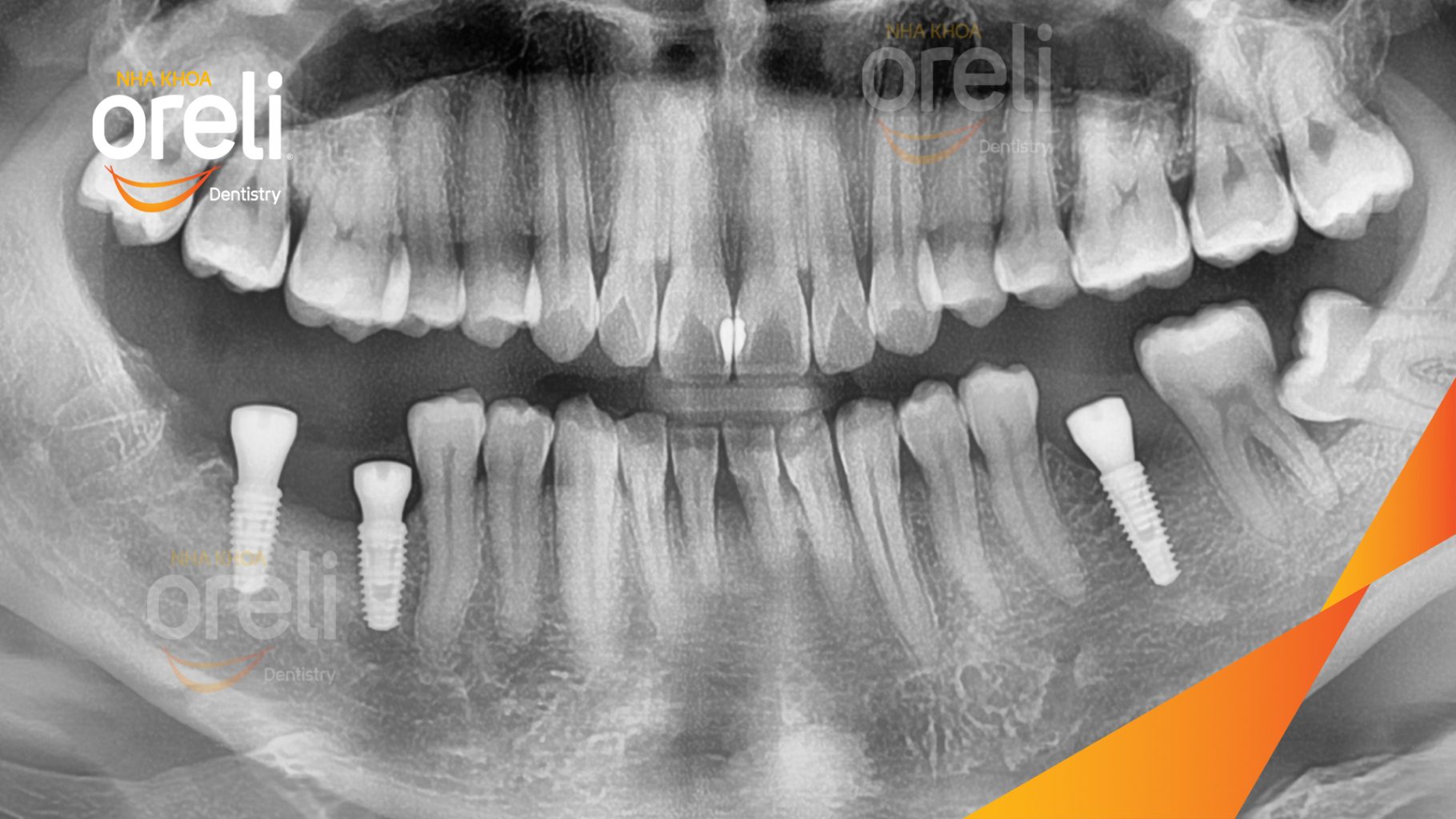 Mất răng hàm dưới trước khi điều trị tại Oreli